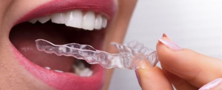 limpieza facil para su ferula dental consejos utiles